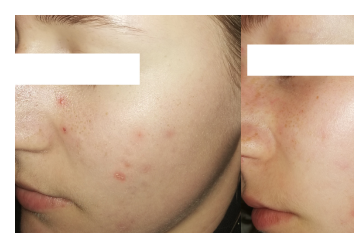 Cera trądzikowa - regulacja sebum i redukcja zmian